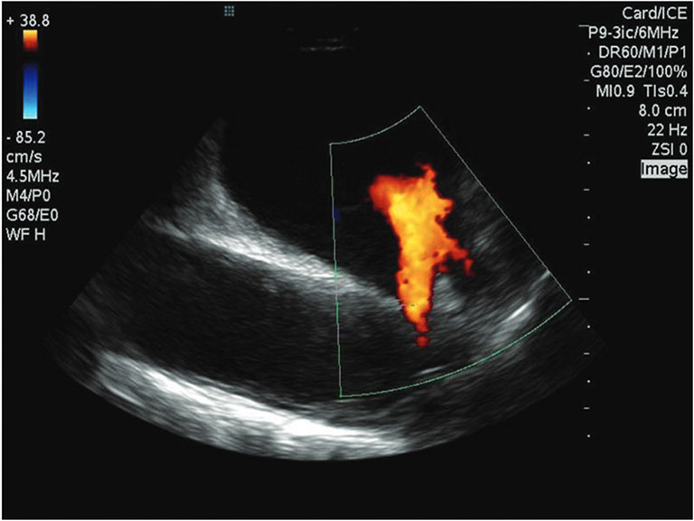 Image of the left pulmonary veins (with blood flow from veins as denoted in orange) as viewed from the right atrium using the ViewFlex™ Xtra ICE Catheter.