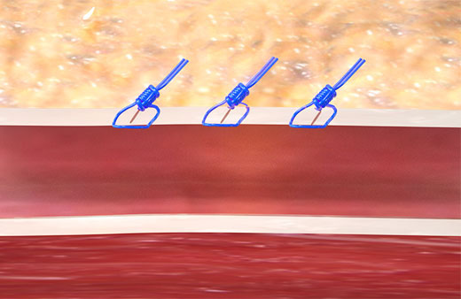 Benefits of suture-mediated repair with Perclose ProGlide™