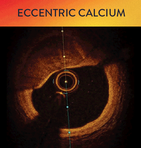   Eccentric calcium