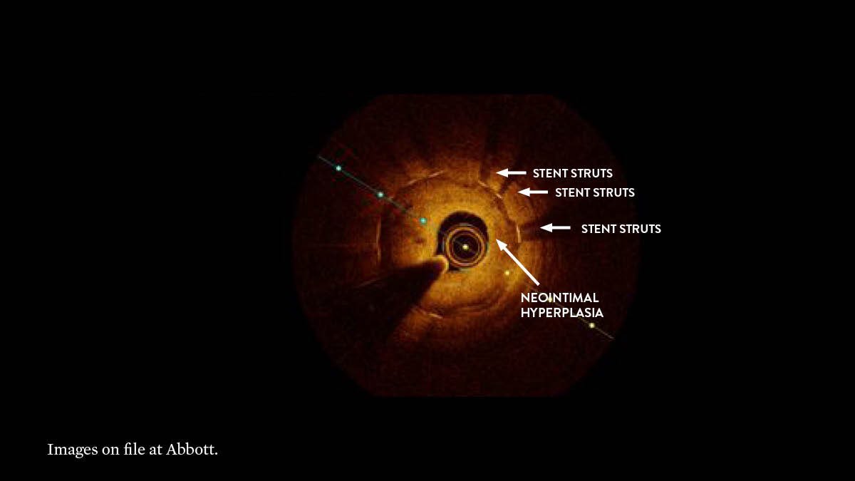 Identify in-stent restenosis with OCT