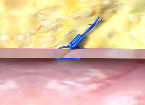  Illustration of suture-based