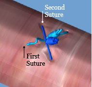  knot advancement of all sutures
