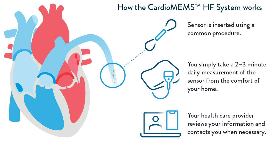 CardioMEMS How it Works