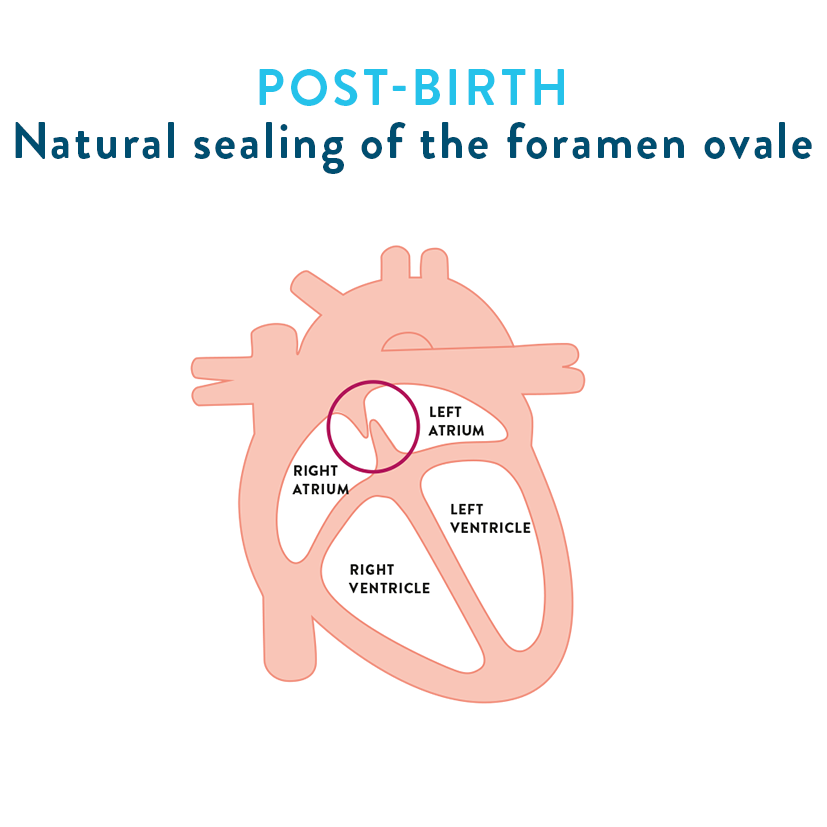 Post-birth, natural sealing of the foramen ovale