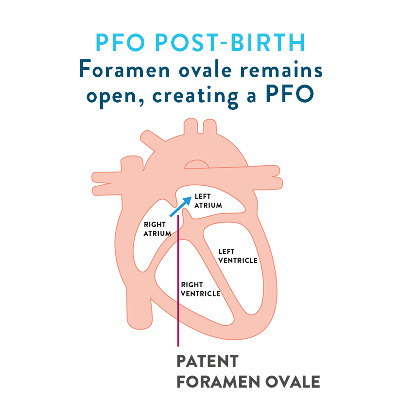 Patent foramen ovale