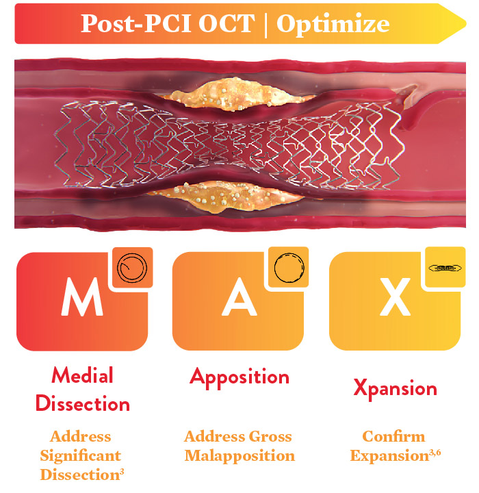 post-PCI coronary interventions
