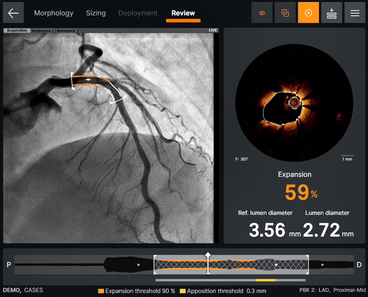 Ultreon™ Software displays post-PCI review screen with stent expansion values