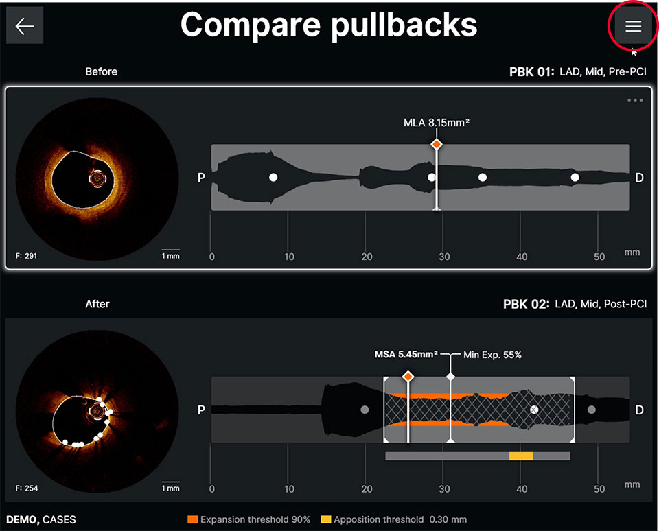 Ultreon™ Software displays pullback comparison screen