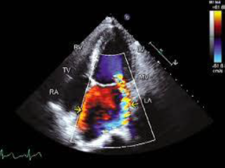 Apical four chamber view showing mitral regurgitation
