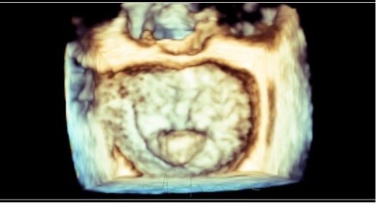 3D enface view of a P2 prolapse