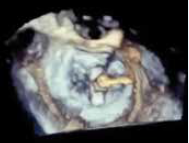 Clip positioning  3D en face view showing clip arms perpendicular to line of coaptation in the Left Atrium