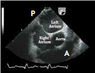 Transseptal Short axis view at base showing anterior-posterior tenting location
