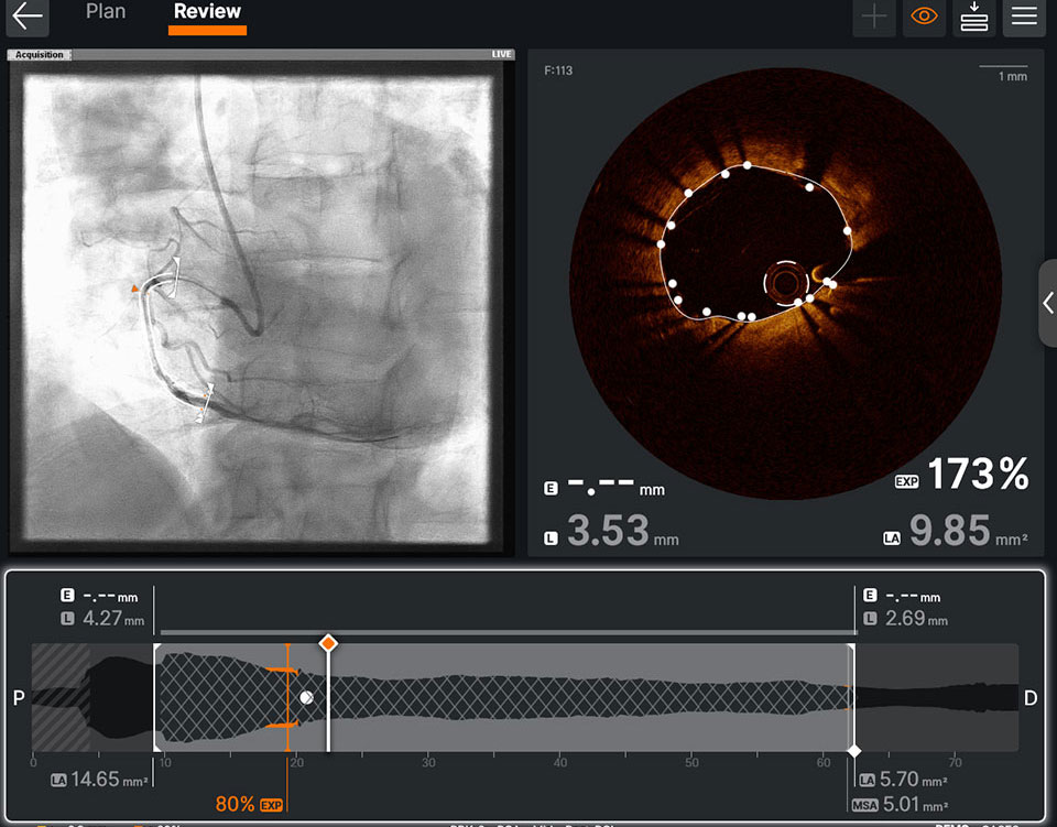 Post-PCI OCT: The OCT software provides post-PCI information on one screen