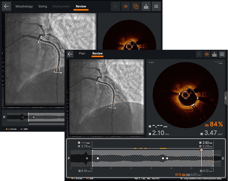 Ultreon Software place the stent