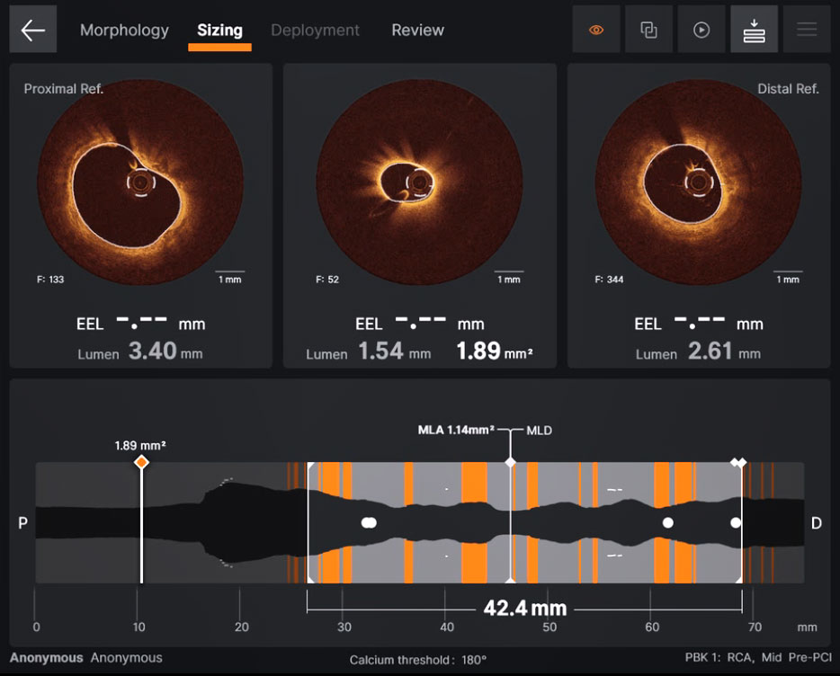 Sizing screen displaying  EEL: proximal and distal frames Lumen diameter: proximal, current and distal frames