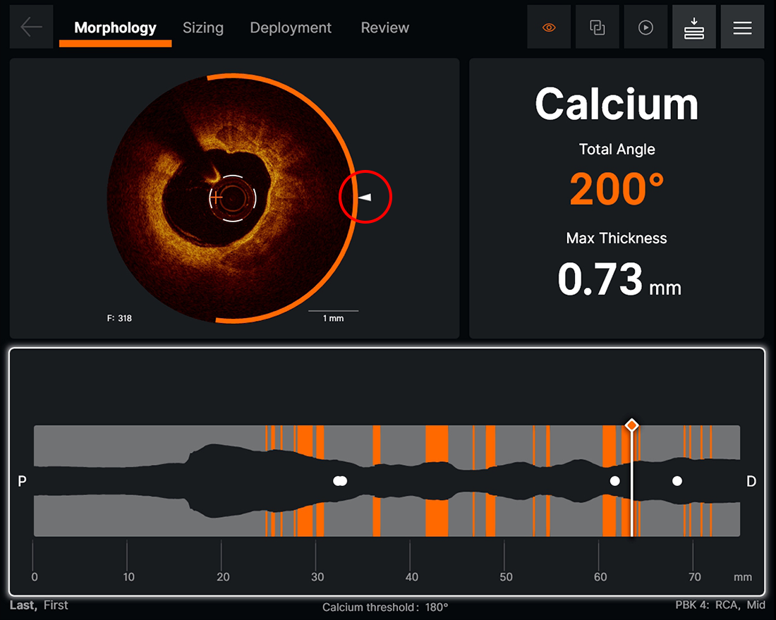 Morphology screen displaying angle and max thickness of calcification