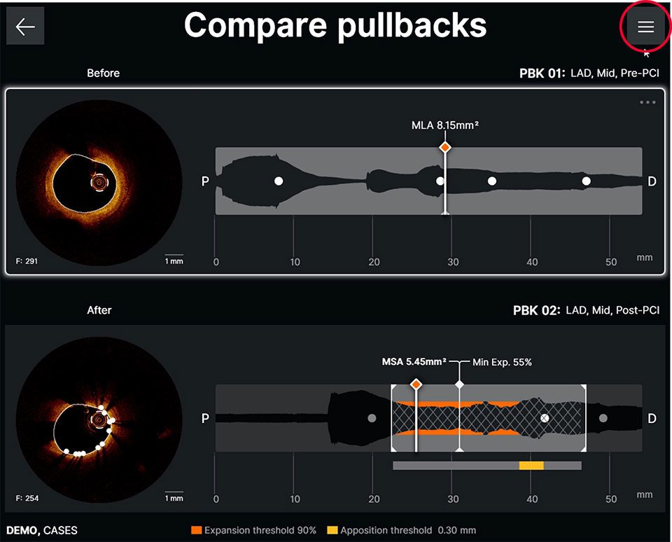 Ultreon™ Software displays pullback comparison screen