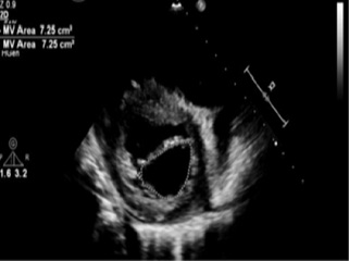 Parasternal short-axis view showing mitral valve area via planimetry