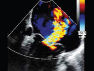 Bi-commissural midline view showing mitral regurgitation with P1/A2/P3 scallops of the mitral valve visualized
