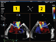 xPlane imaging showing the simultaneous (1) bicommissural and (2) long axis views of  the A2/P2 scallops of the mitral valve (with Colour Doppler)