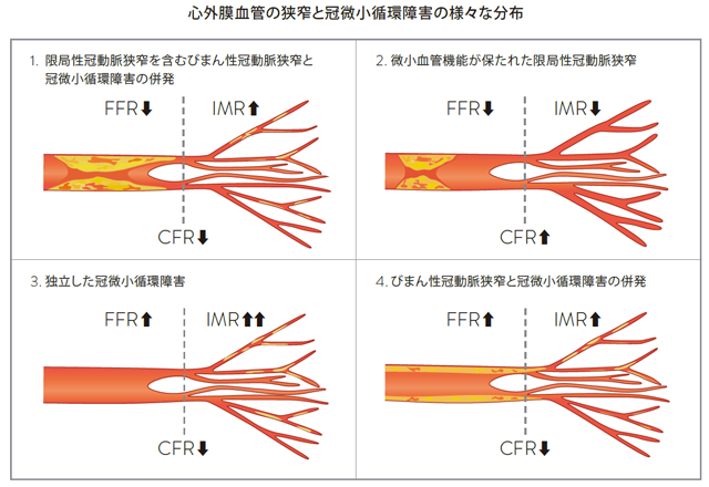 心外膜血管の狭窄と冠微小循環障害の様々な分布