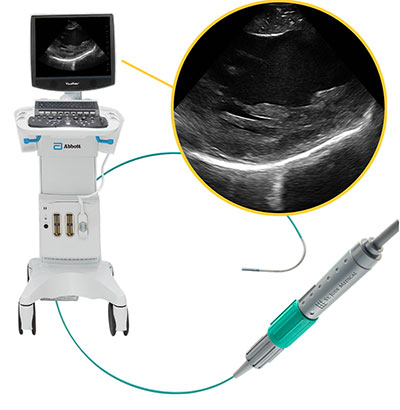 ViewMate Ultrasound Console & ViewFlex Xtra ICE Catheter
