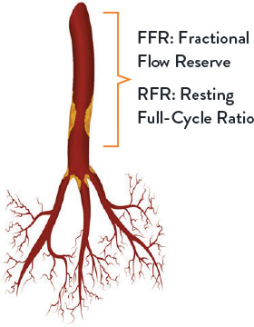 Determining the Need for Revascularization