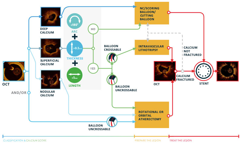 OCT-guided algorithm to treat calcified lesions
