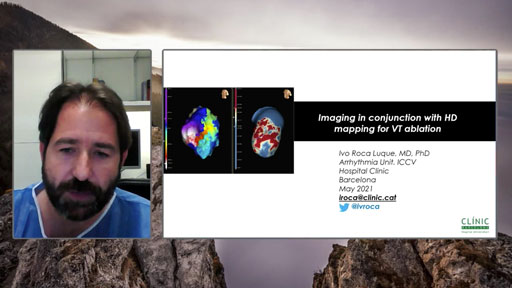 Dr. Roca Luque shares his experience on the combination of Advanced Imaging Techniques and the HD Grid Mapping for the VT treatment