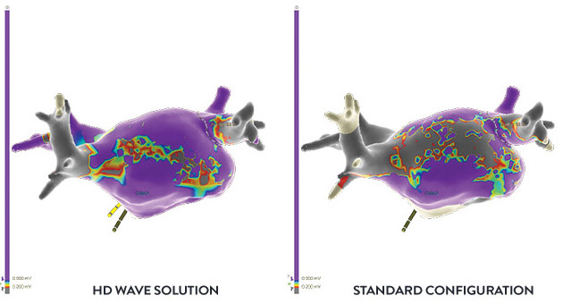 Comparison of HD Grid cardiac mapping versus standard configuration cardiac mapping.