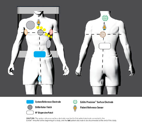 Two human models with EnSite Precision cardiac mapping electrode information overlaid on top.
