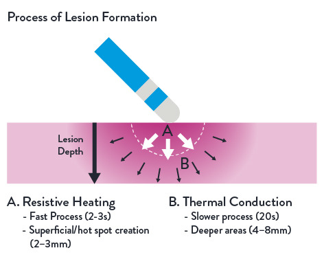 Visual depiction of lesion formation.