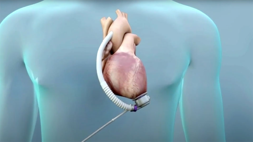 Implantation Procedure Introduction
