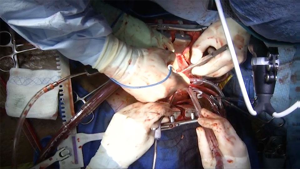 Anastomosing the Outflow Graft to the Ascending Aorta Video