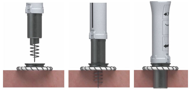 Three illustrations of the HeartMate 3 coring tool at different stages of the coring process
