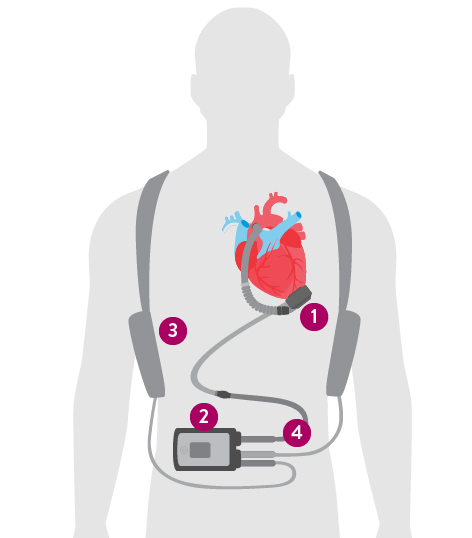 Silhouette of figure with HeartMate 3 LVAD and components overlaid on his figure.