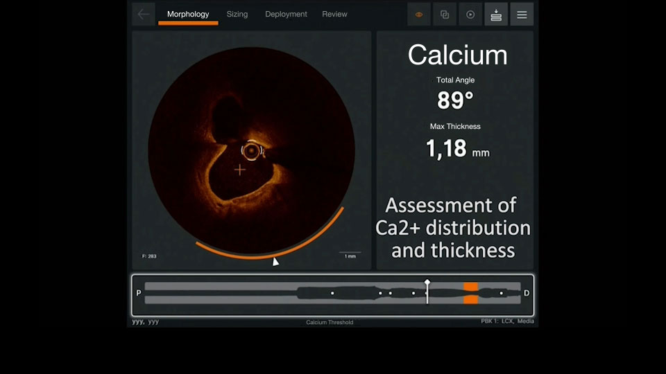 Ultreon 1.0 Software Coronary Calcium