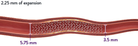 XIENCE Skypoint Stent can treat tapered vessels with a diameter of 3.5 mm up to 5.75 mm. 