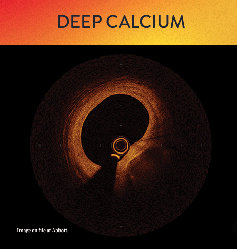 OCT classification of deep calcium