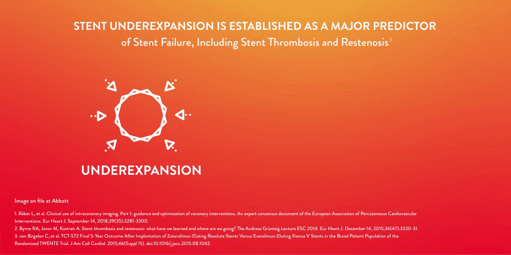stent underexpansion is established as a major predictor of stent failure