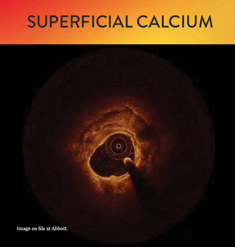 OCT classification of superficial calcium