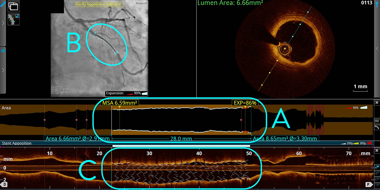 OCT Tapered Stent Expansion