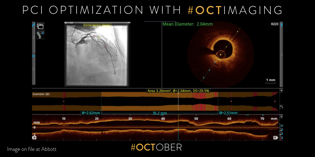How to optimize PCI with OCT imaging