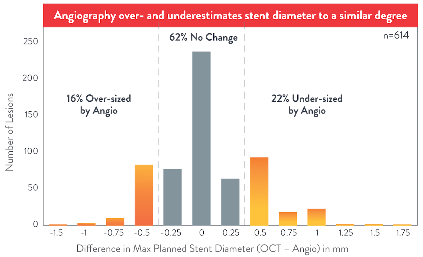 Angiography over and underestimates stent diameter to a similar degree
