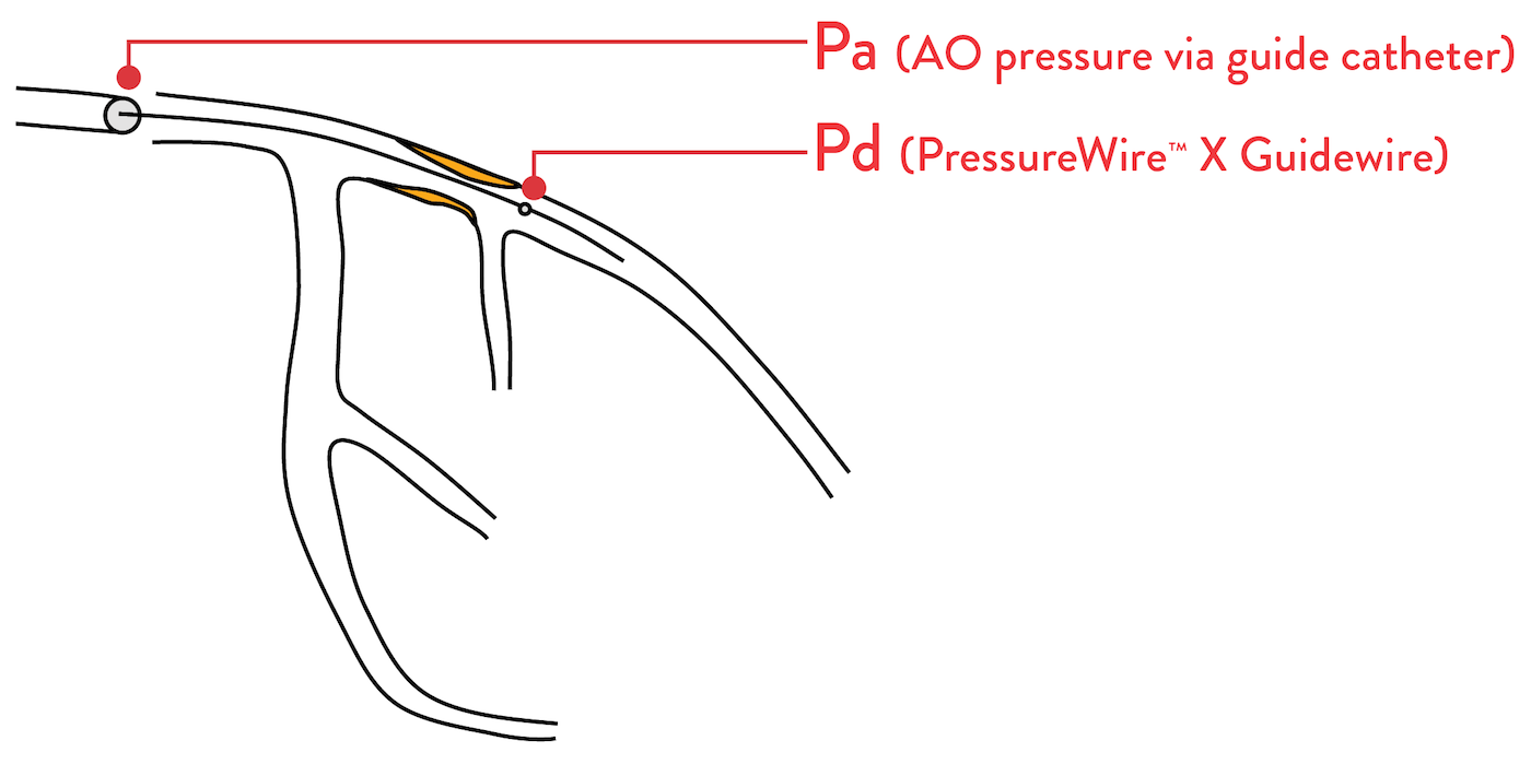 PressureWire™ X Guidewire measuring Pa (aortic pressure) and Pd values