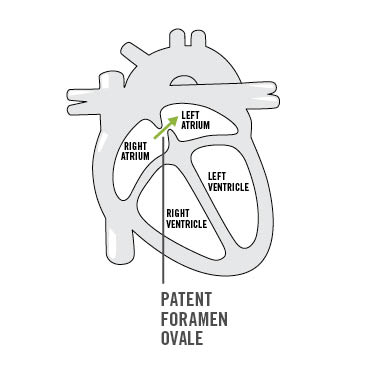 diagram of a heart showing a PFO
