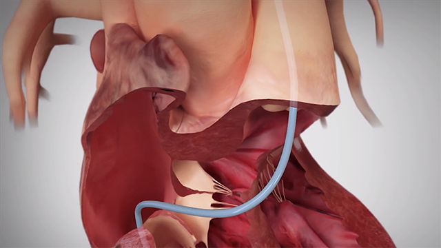 CardioMEMS Implant Animation