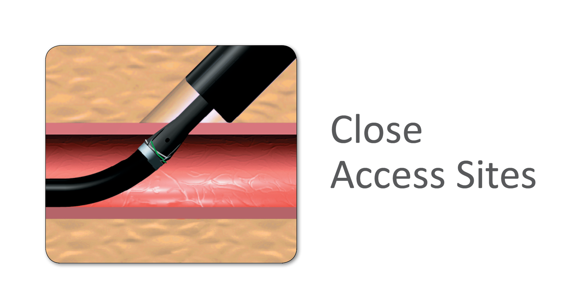 Prostar Close Access Sites