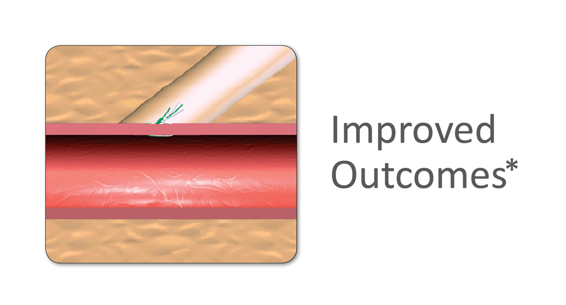 Prostar Improved Outcomes
