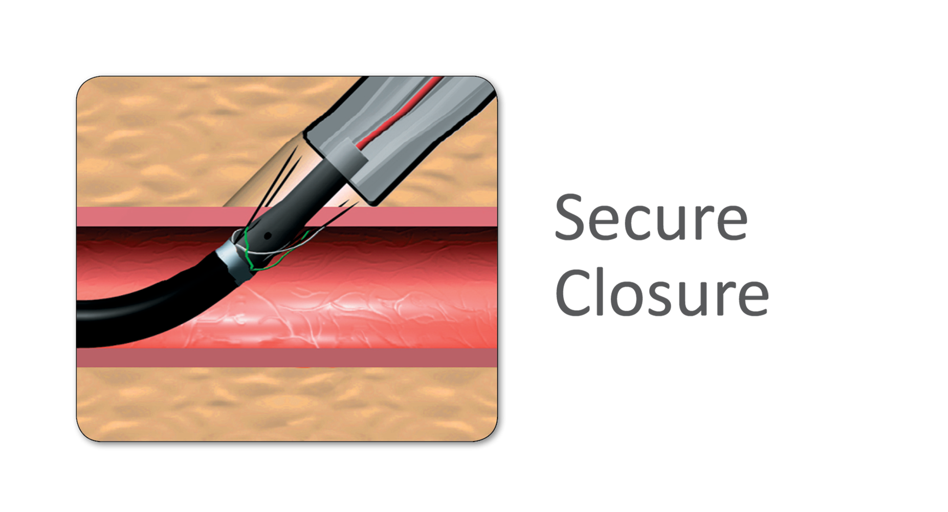 Prostar Secure Closure